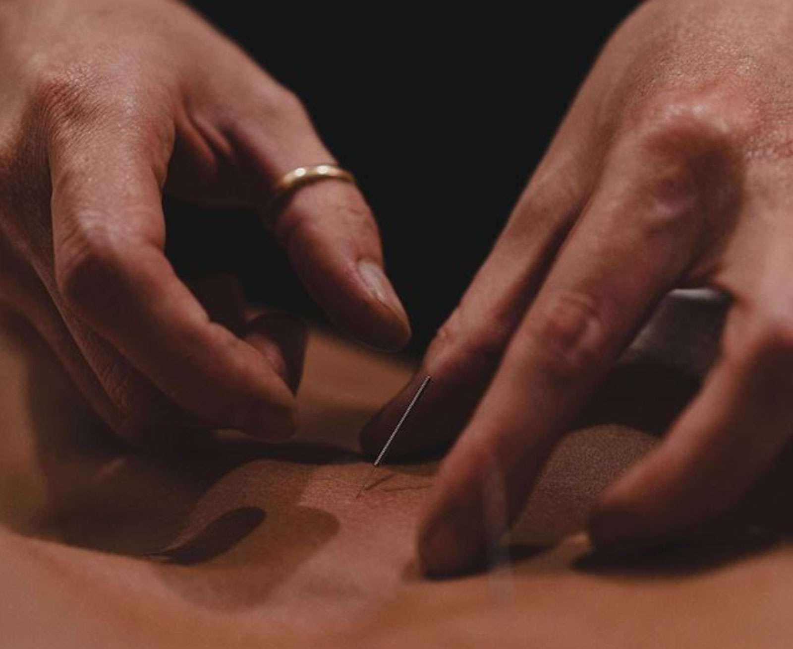 Acupuncture at Being, Coolangatta